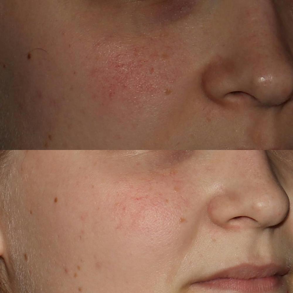 V Beam Before & After Gallery - Patient 122362852 - Image 1