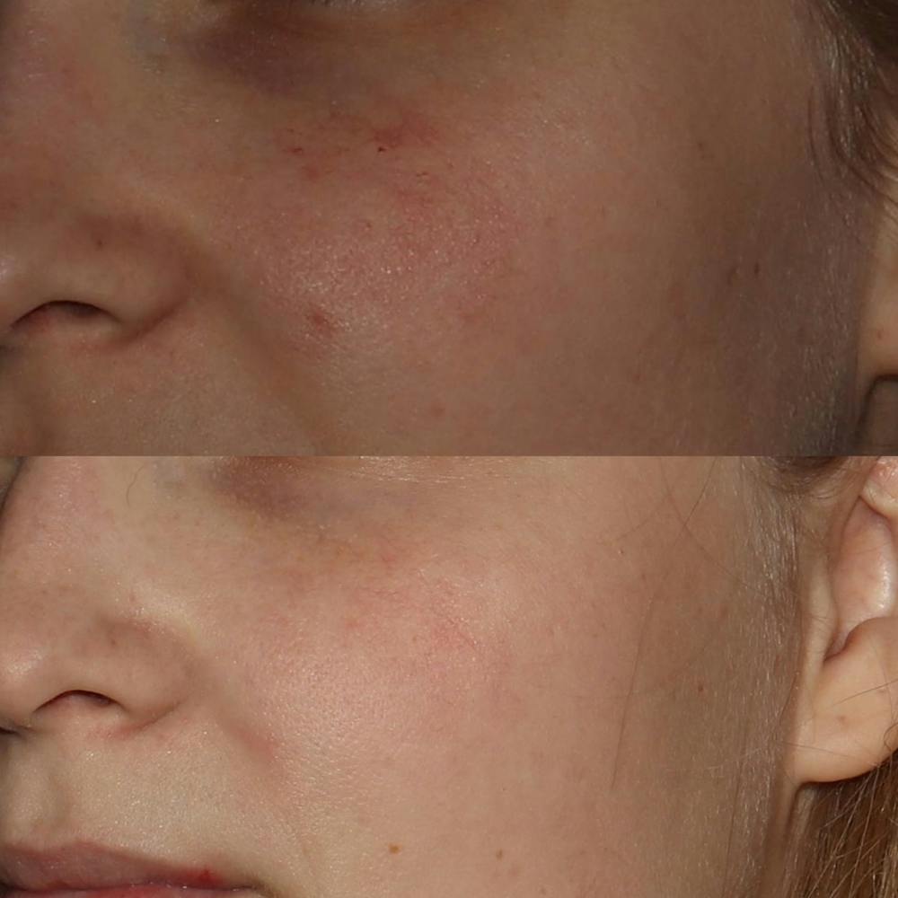 V Beam Before & After Gallery - Patient 122362852 - Image 2