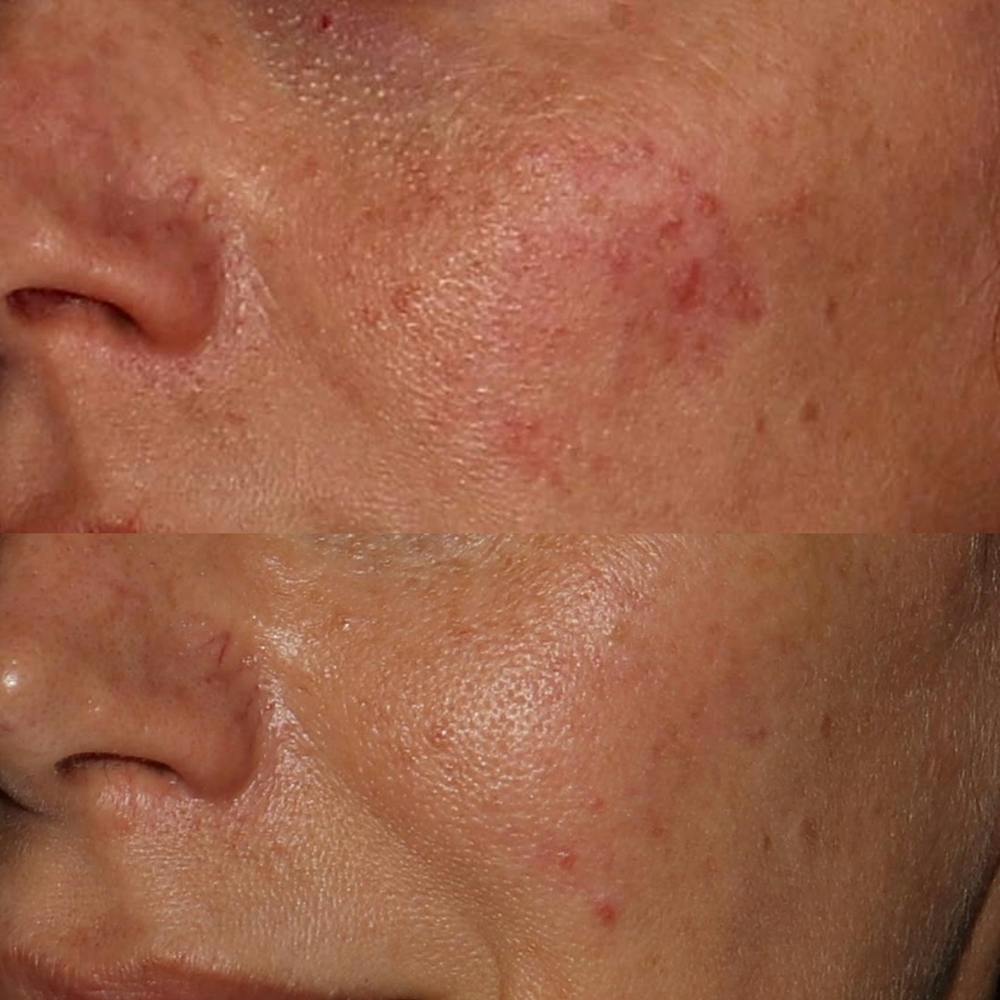V Beam Before & After Gallery - Patient 122362851 - Image 2