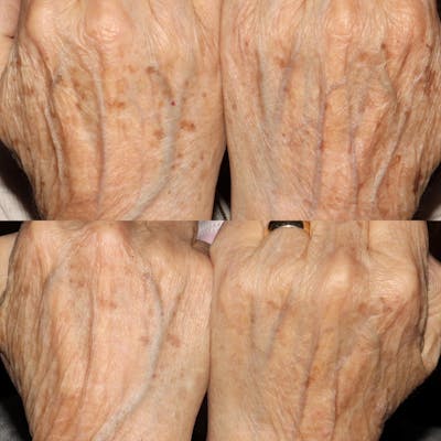 IPL Before & After Gallery - Patient 122389998 - Image 1