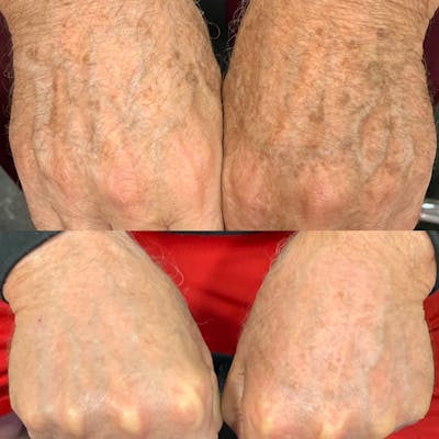 IPL Before & After Gallery - Patient 122389999 - Image 1