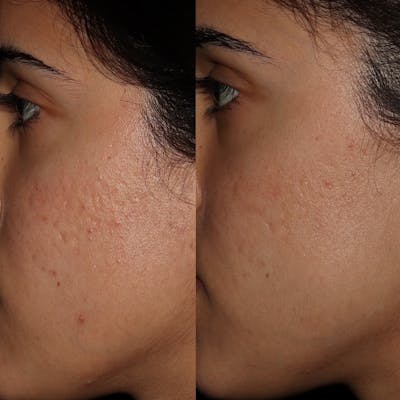 Skin Pen Microneedling Before & After Gallery - Patient 122390002 - Image 1