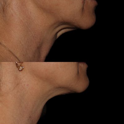 Muscle Relaxants Before & After Gallery - Patient 122392642 - Image 1