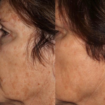 IPL Before & After Gallery - Patient 142815003 - Image 2