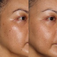 IPL Before & After Gallery - Patient 142815003 - Image 1