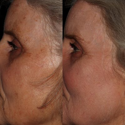Cosemelan Peel Before & After Gallery - Patient 142815036 - Image 1