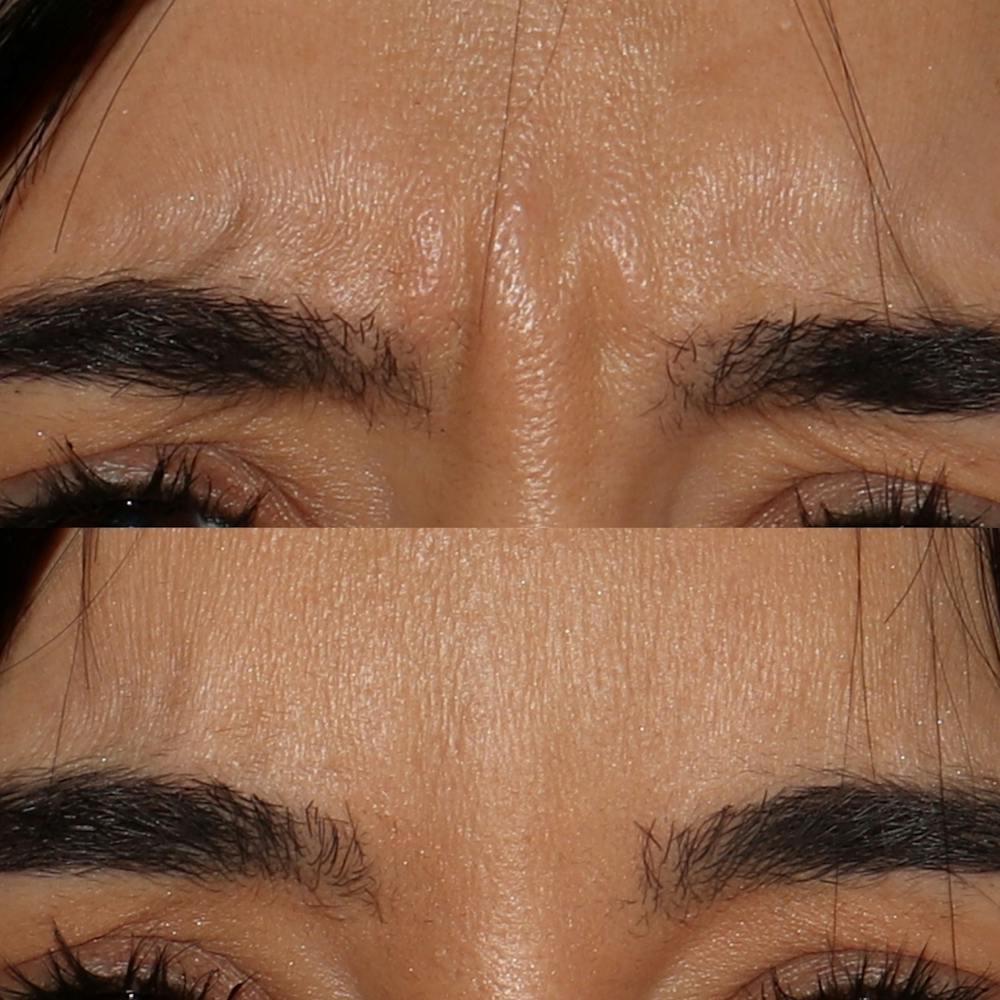 Botox Before & After Gallery - Patient 142815047 - Image 1