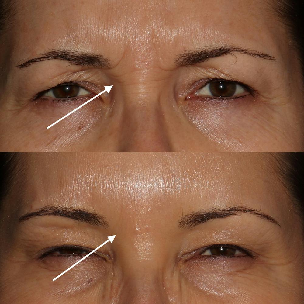 Botox Before & After Gallery - Patient 142815046 - Image 1