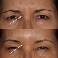 Botox Before & After Gallery - Patient 142815046 - Image 1