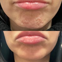 Botox Before & After Gallery - Patient 142815045 - Image 1