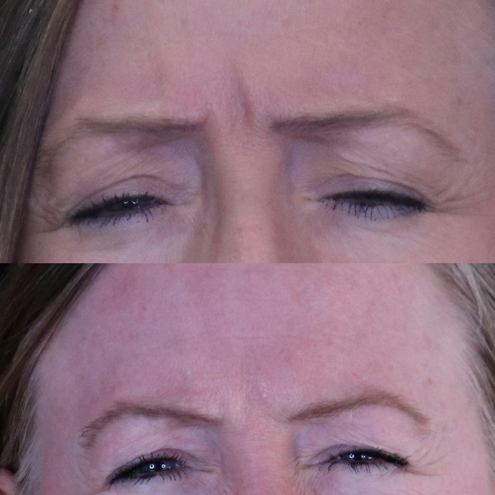 Botox Before & After Gallery - Patient 142815044 - Image 1
