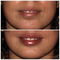 Lips Before & After Gallery - Patient 142815068 - Image 1