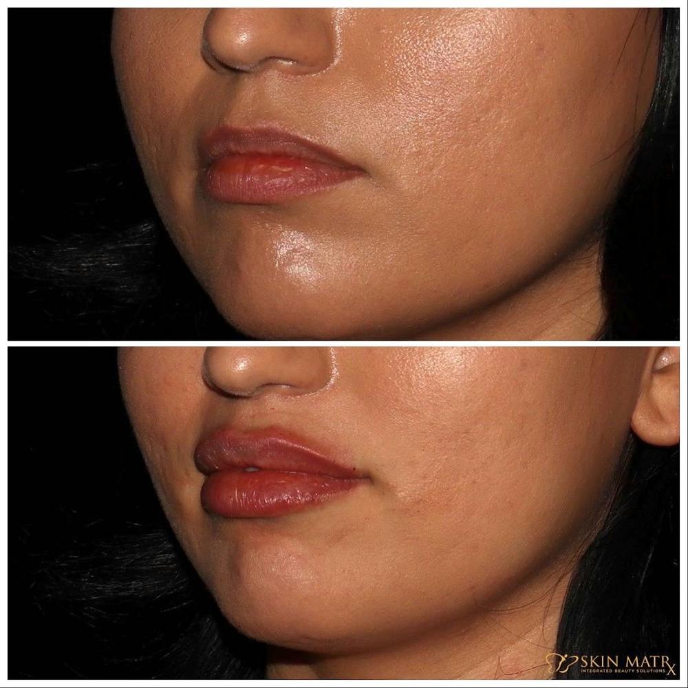 Lips Before & After Gallery - Patient 142815067 - Image 2