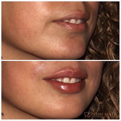 Lips Before & After Gallery - Patient 142815068 - Image 2