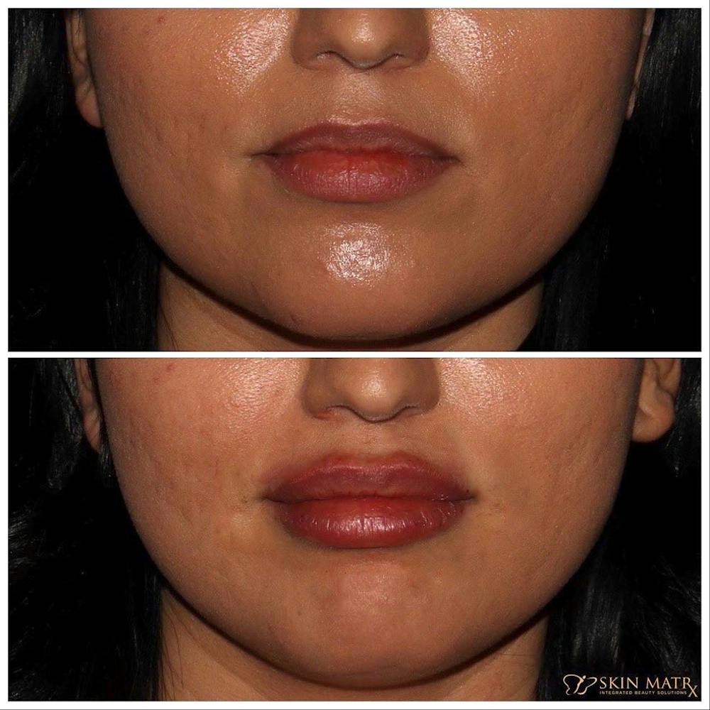 Lips Before & After Gallery - Patient 142815067 - Image 1