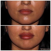 Lips Before & After Gallery - Patient 142815067 - Image 1