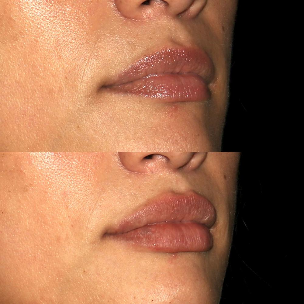 Lips Before & After Gallery - Patient 142815066 - Image 2