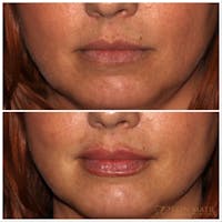 Lips Before & After Gallery - Patient 142815065 - Image 1