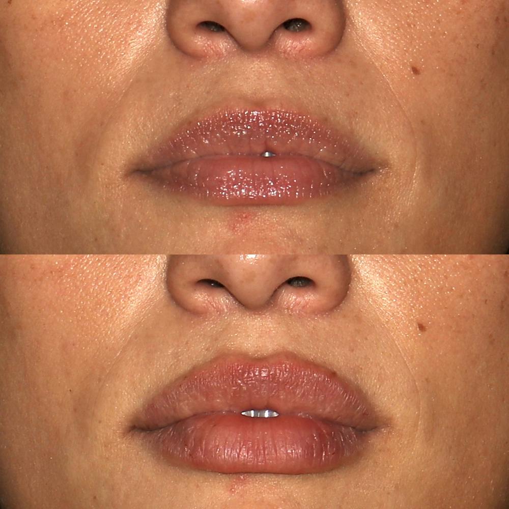 Lips Before & After Gallery - Patient 142815066 - Image 1