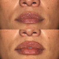 Lips Before & After Gallery - Patient 142815066 - Image 1