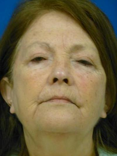 Combo Procedures Before & After Gallery - Patient 255444 - Image 1