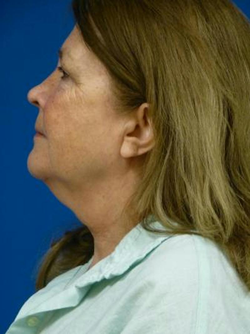 Combo Procedures Before & After Gallery - Patient 255444 - Image 5