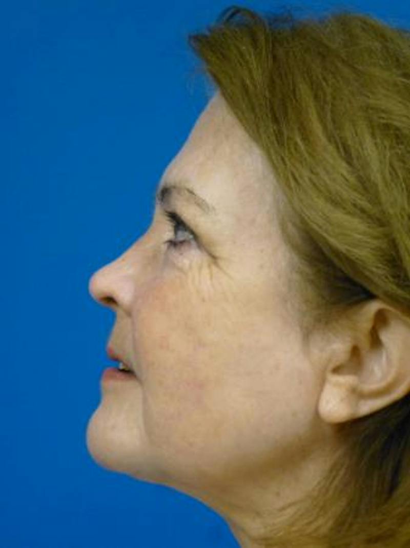 Combo Procedures Before & After Gallery - Patient 255444 - Image 6