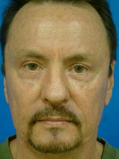 Combo Procedures Before & After Gallery - Patient 294741 - Image 2