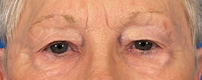 Combo Procedures Before & After Gallery - Patient 363774 - Image 1