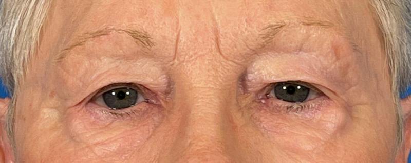 Combo Procedures Before & After Gallery - Patient 363774 - Image 1