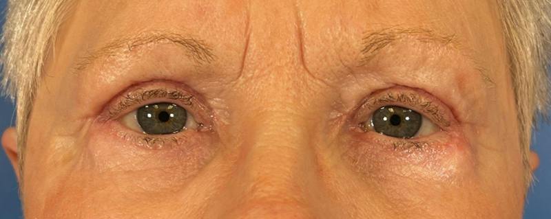 Combo Procedures Before & After Gallery - Patient 363774 - Image 2