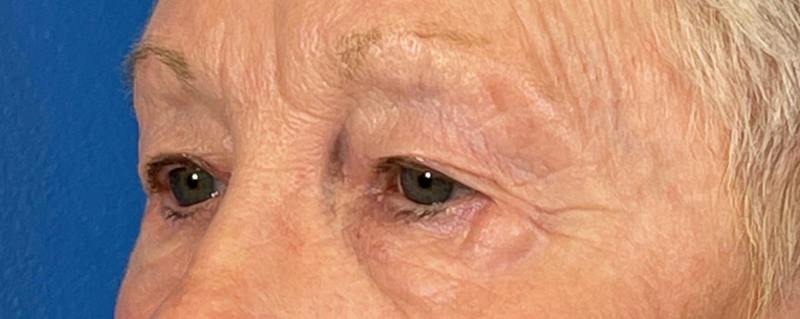 Combo Procedures Before & After Gallery - Patient 363774 - Image 3