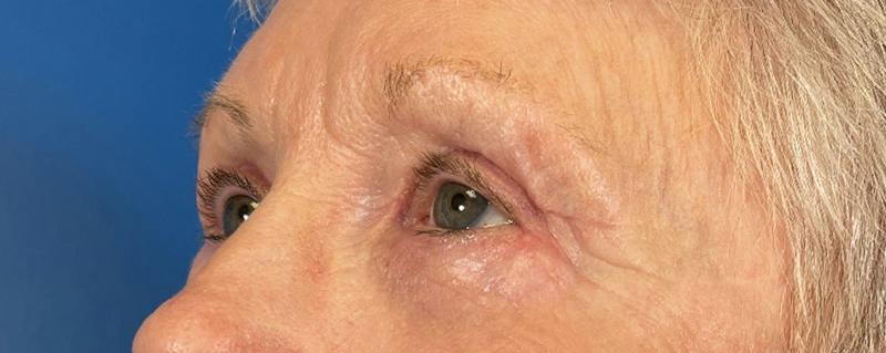 Combo Procedures Before & After Gallery - Patient 363774 - Image 4