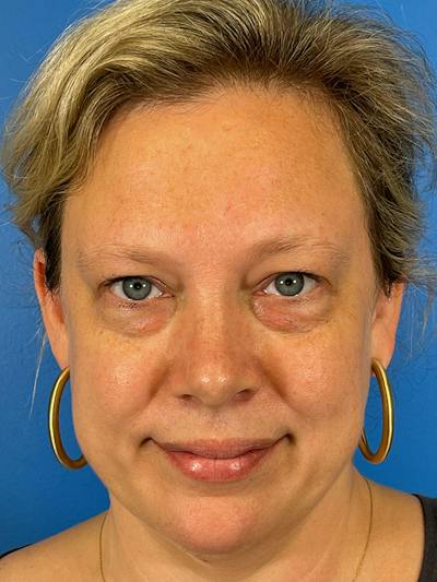 Combo Procedures Before & After Gallery - Patient 287536 - Image 1