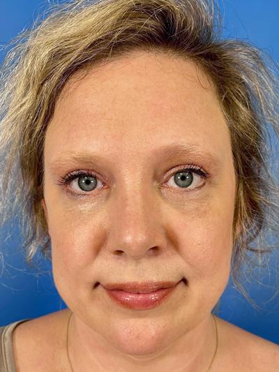 Combo Procedures Before & After Gallery - Patient 287536 - Image 2