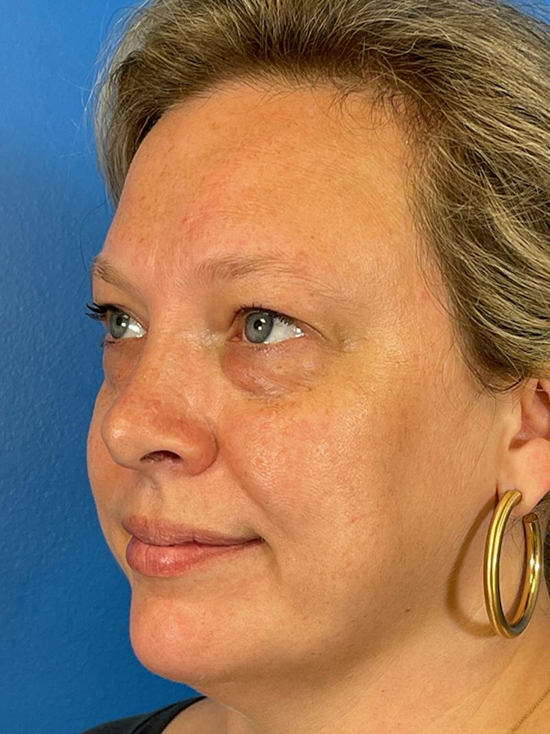 Combo Procedures Before & After Gallery - Patient 287536 - Image 3