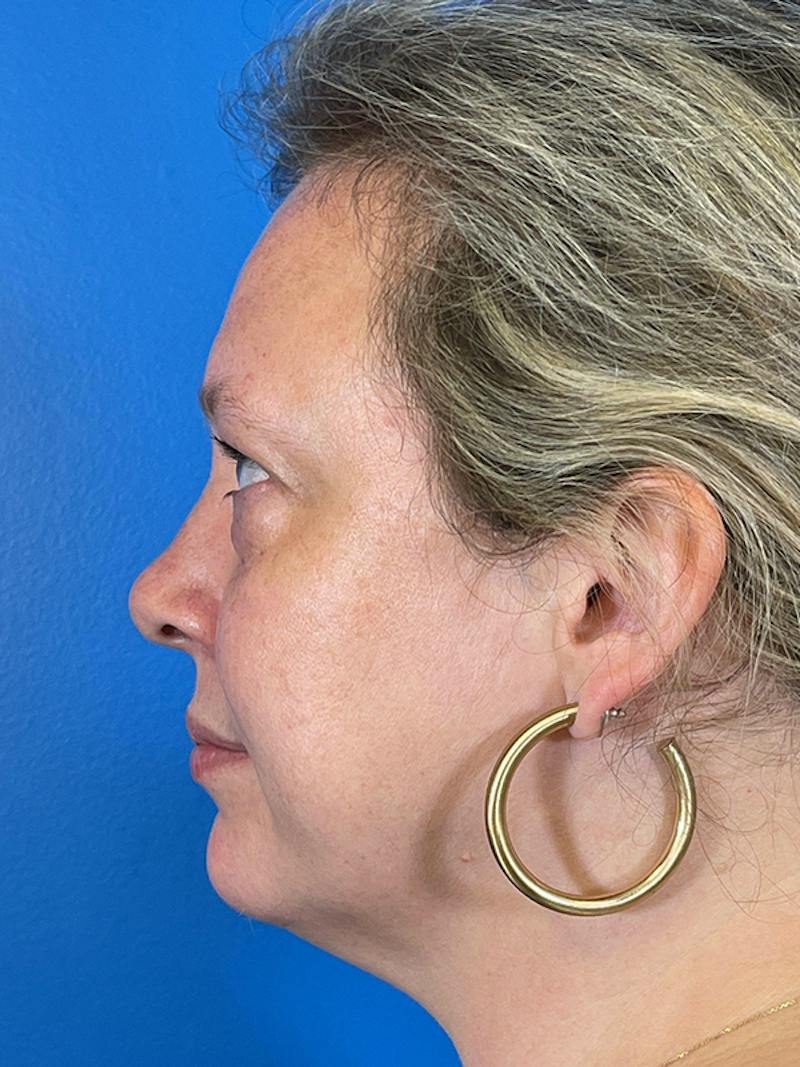 Combo Procedures Before & After Gallery - Patient 287536 - Image 5