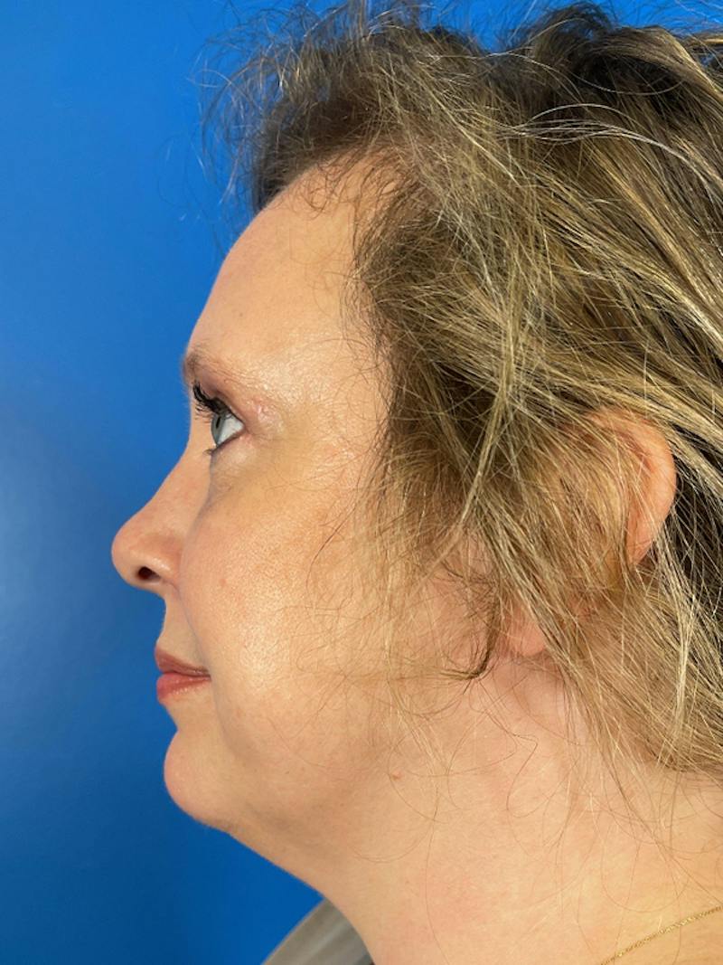 Combo Procedures Before & After Gallery - Patient 287536 - Image 6