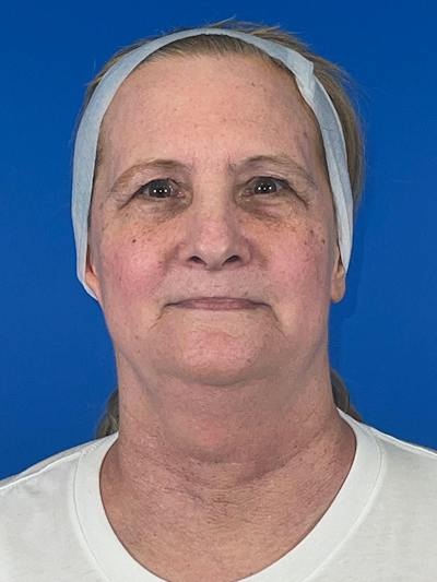 Combo Procedures Before & After Gallery - Patient 186242 - Image 1