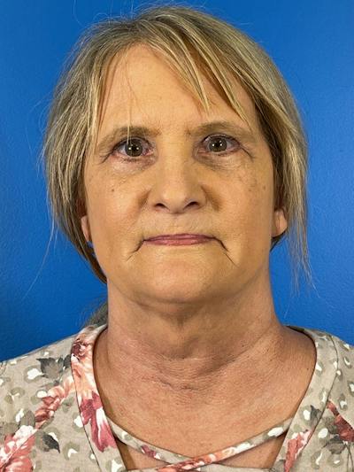 Combo Procedures Before & After Gallery - Patient 186242 - Image 2