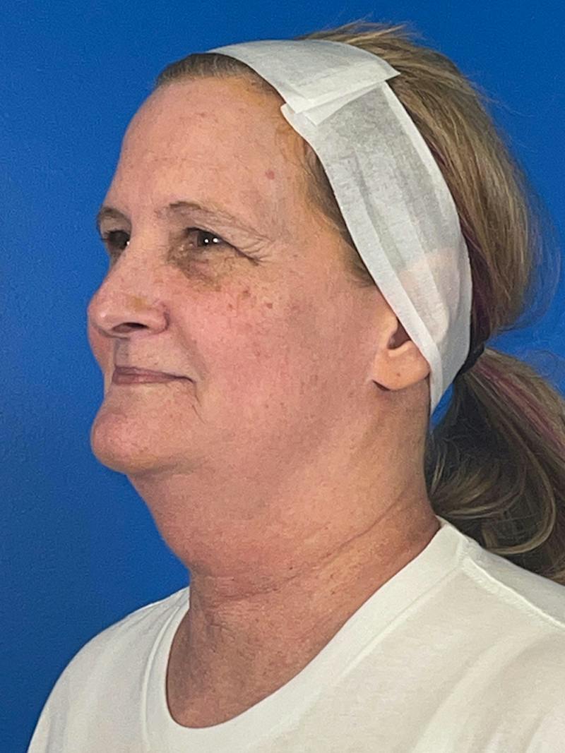 Combo Procedures Before & After Gallery - Patient 186242 - Image 3
