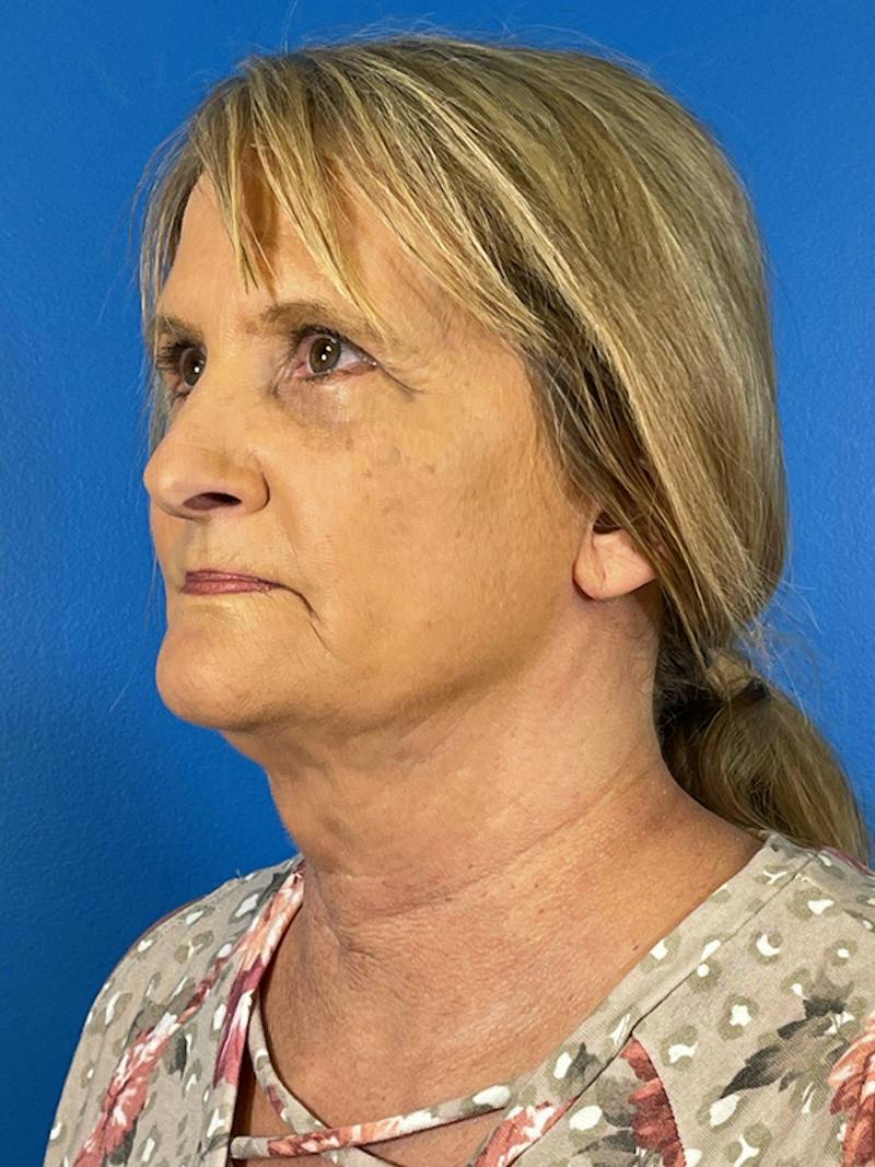 Combo Procedures Before & After Gallery - Patient 186242 - Image 4