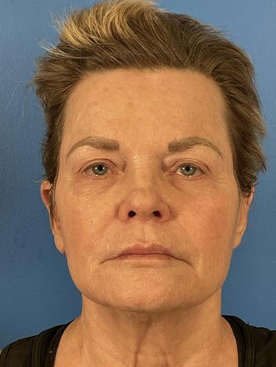 Eyelid Lift Before & After Gallery - Patient 147247 - Image 1