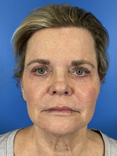 Eyelid Lift Before & After Gallery - Patient 147247 - Image 2