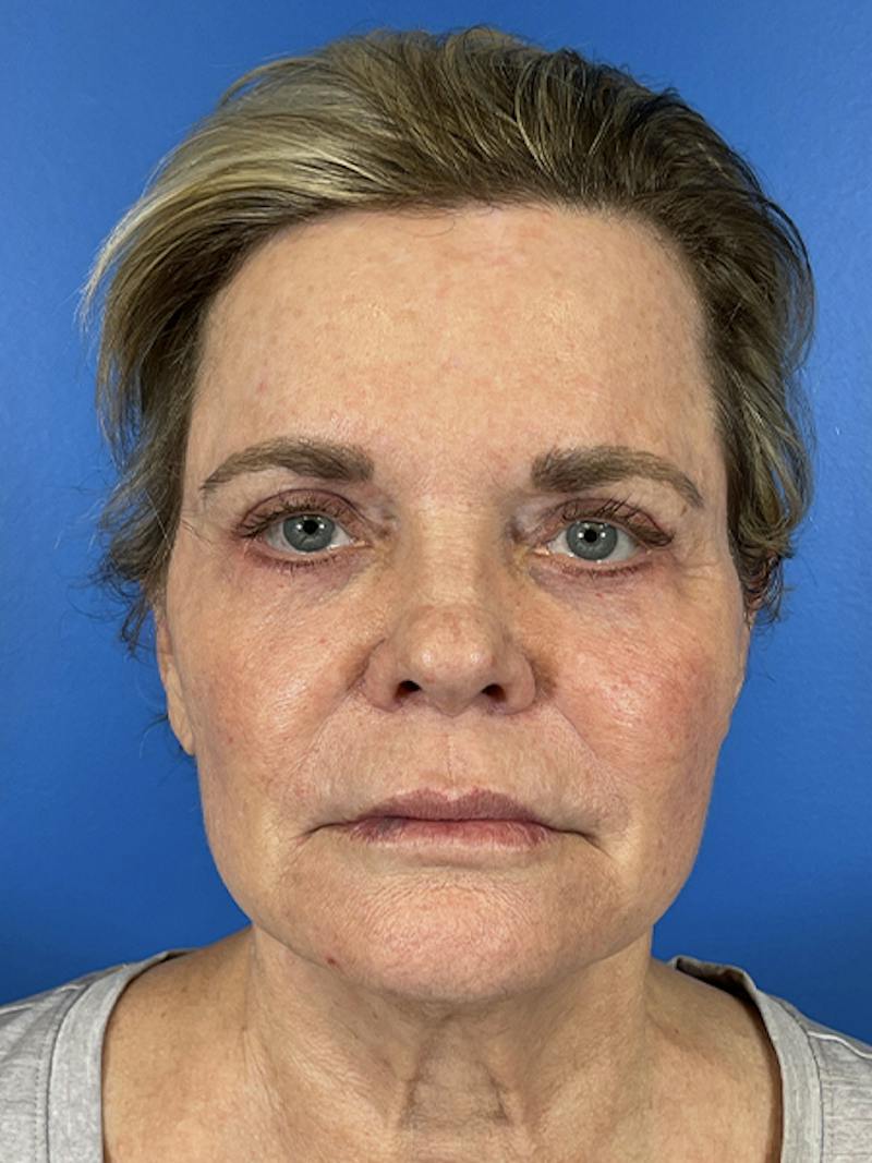 Eyelid Lift Before & After Gallery - Patient 147247 - Image 2