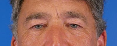 Eyelid Lift Before & After Gallery - Patient 391533 - Image 1