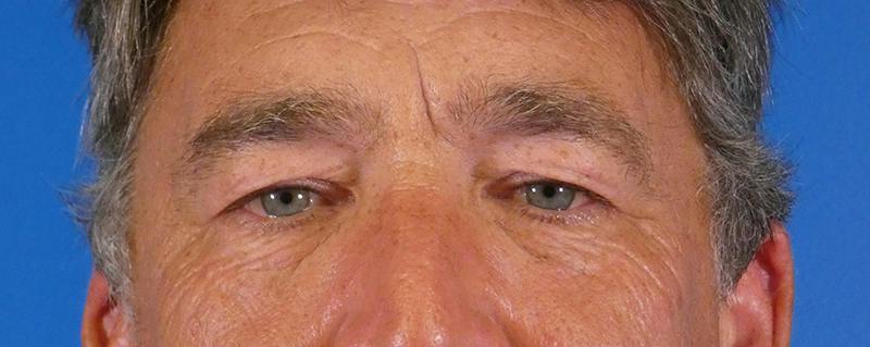 Eyelid Lift Before & After Gallery - Patient 391533 - Image 1