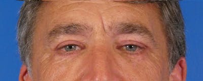 Eyelid Lift Before & After Gallery - Patient 391533 - Image 2
