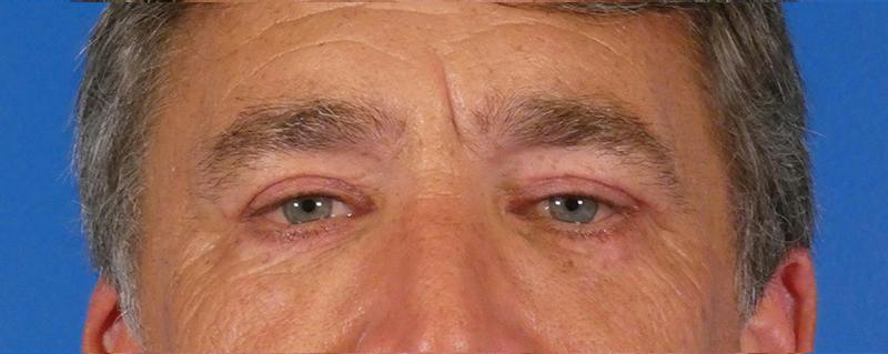 Eyelid Lift Before & After Gallery - Patient 391533 - Image 2