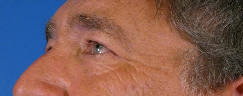 Eyelid Lift Before & After Gallery - Patient 391533 - Image 3